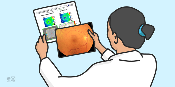 Managing Hydroxychloroquine Retinopathy in High-Risk Patients: A Case Report