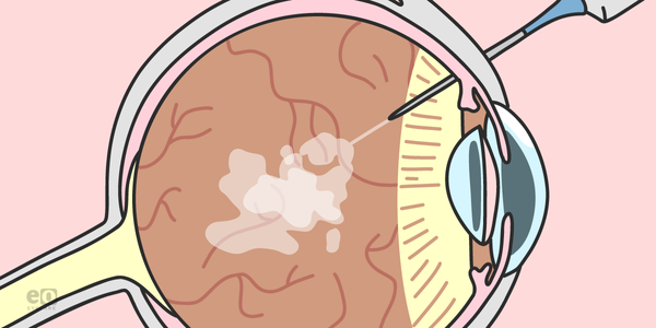 Anti-VEGF Therapy: An Ophthalmology Resident's Guide