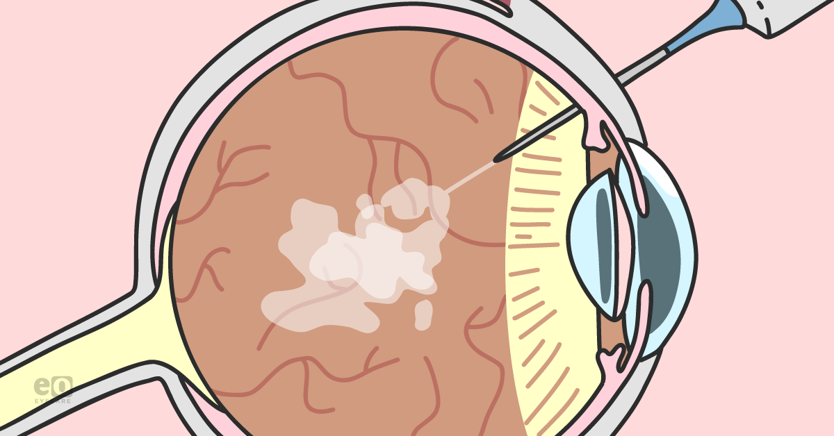 Anti-VEGF Therapy: An Ophthalmology Resident's Guide