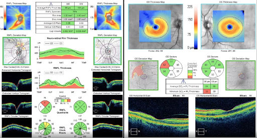 OCT RNFL and Ganglion Cell Analysis