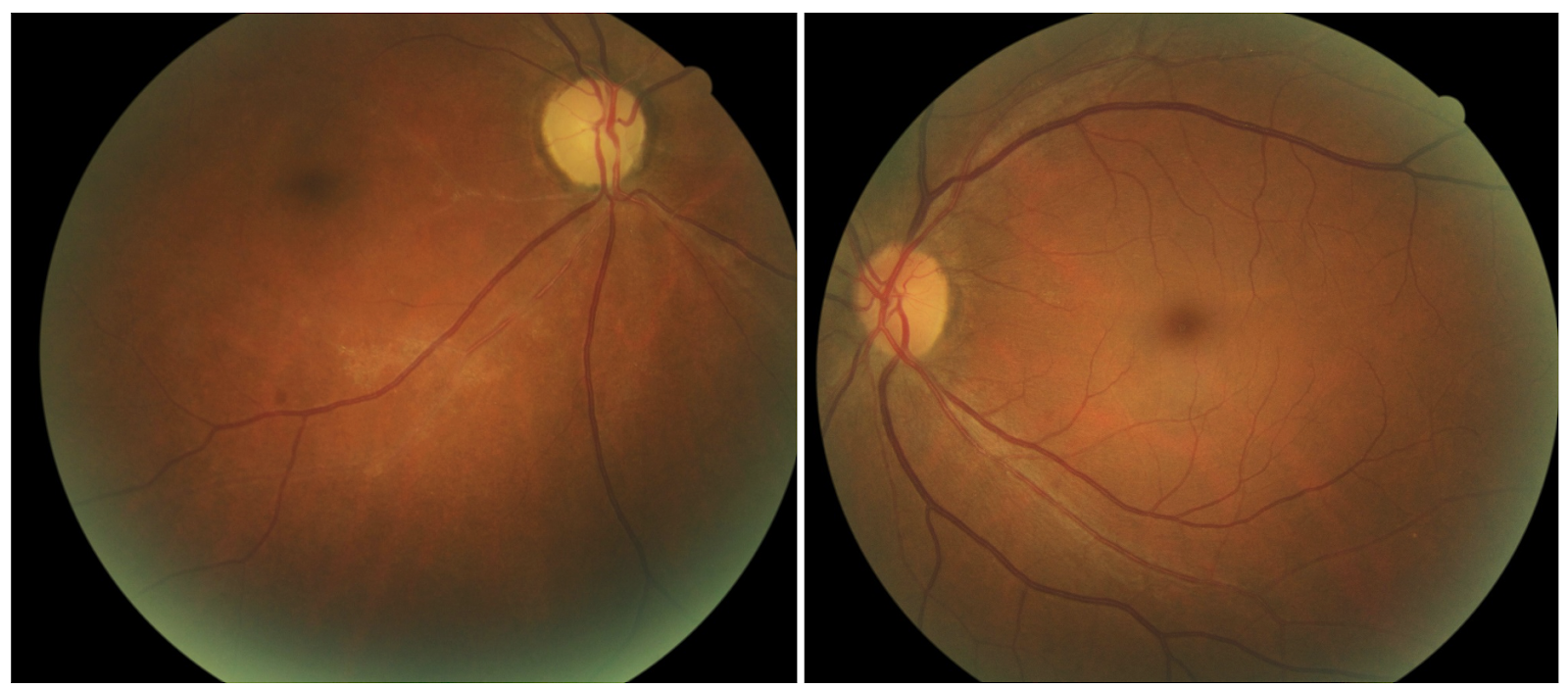 Retinal non-perfusion - Unexplained pallor