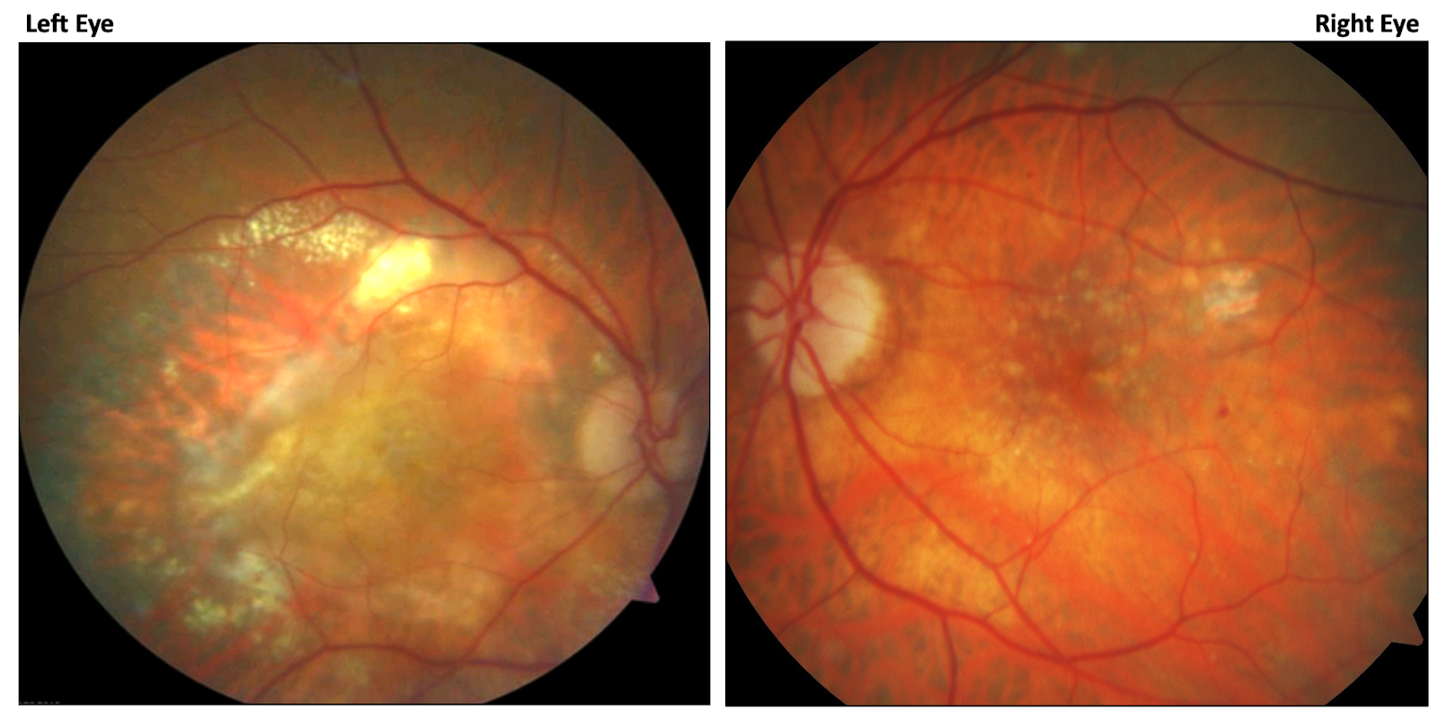 Choroidal Neovascularization Case study 3 eye