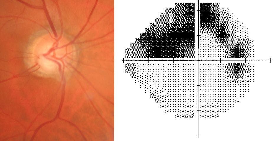 Glaucoma