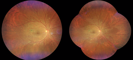 Peripheral Retinopathy Lesions