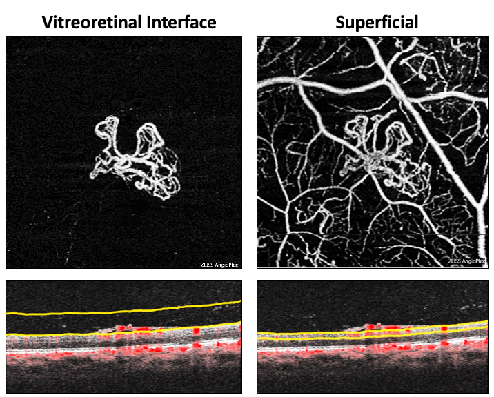 Vitreoretinal Interface