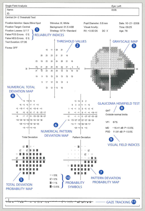 Humphrey VFA single field analysis