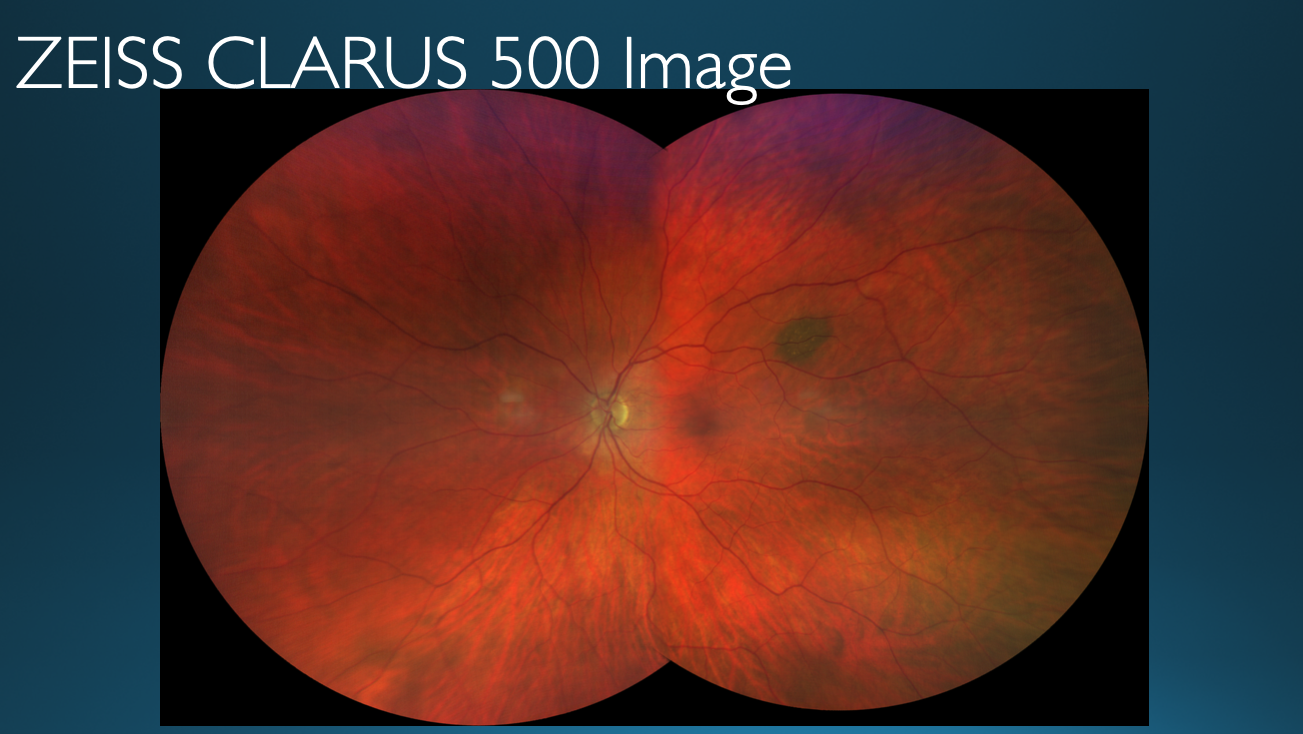 Figure 9: A choroidal nevus is seen in the upper temporal quadrant of the patient’s left eye