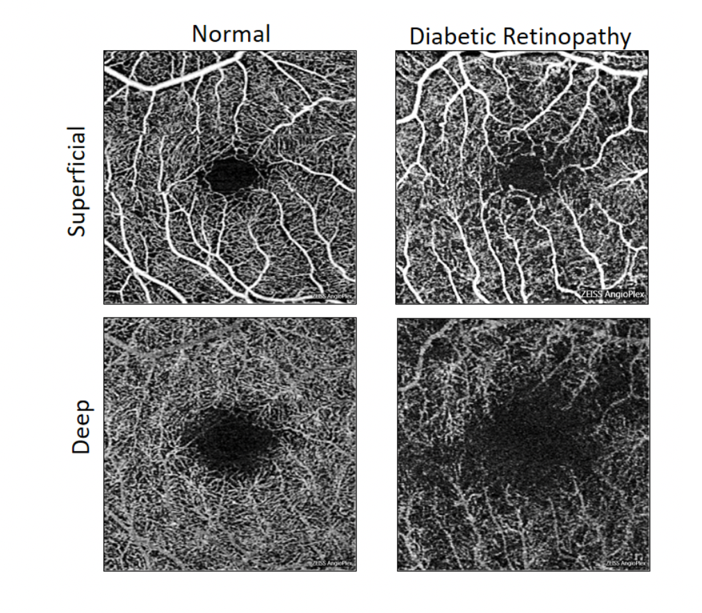 6x6mm OCTA scans indicating early detection of DR