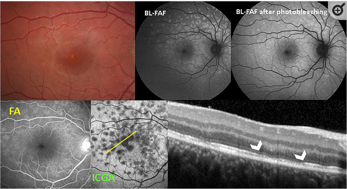 Hyperautofluorescent Lesions