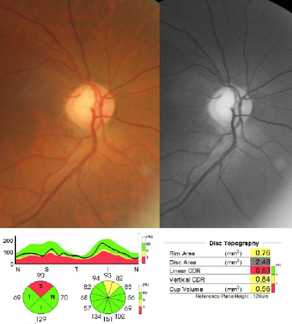 Primary open angle glaucoma