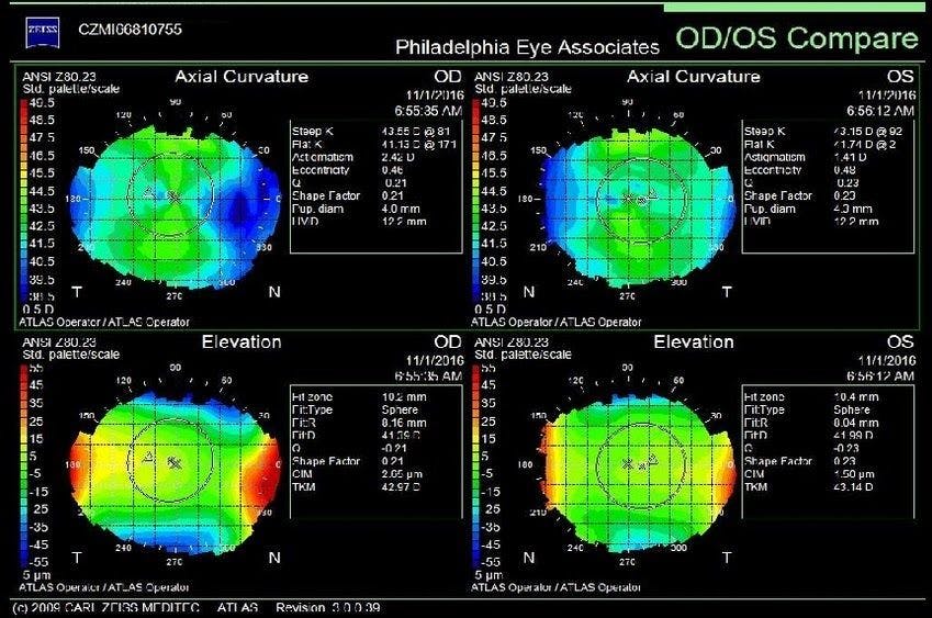 jjv astigmatism figure 1.jpeg