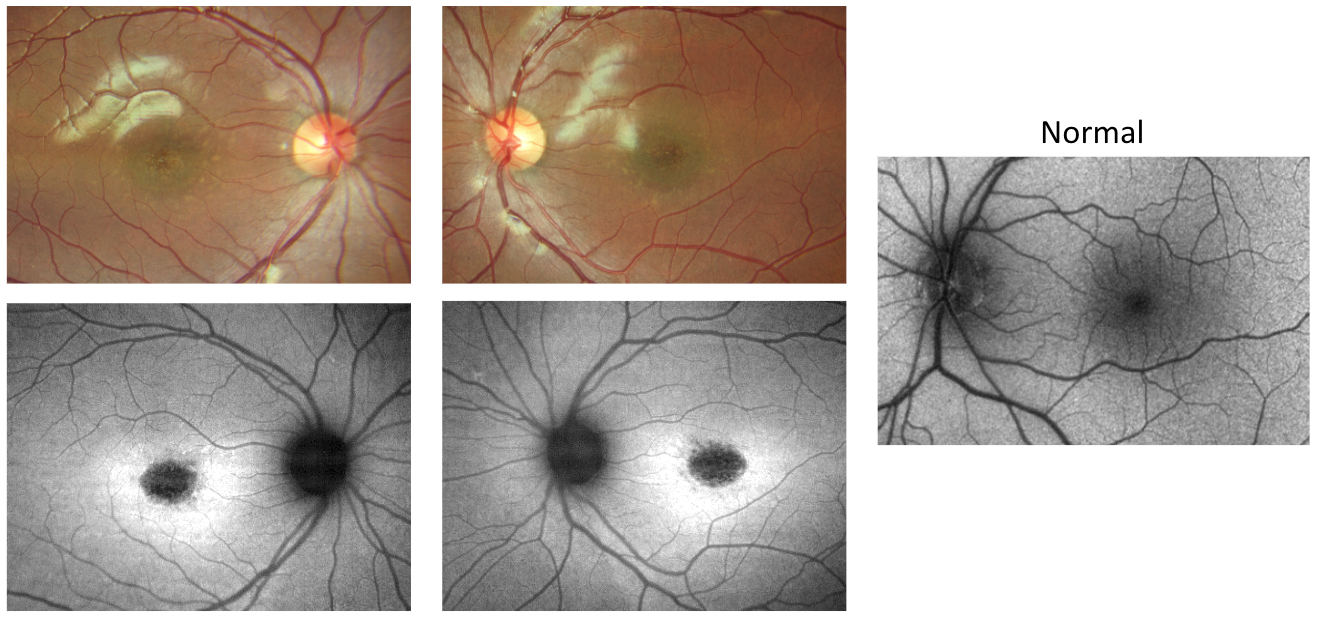 Fundus autofluorescence IRD