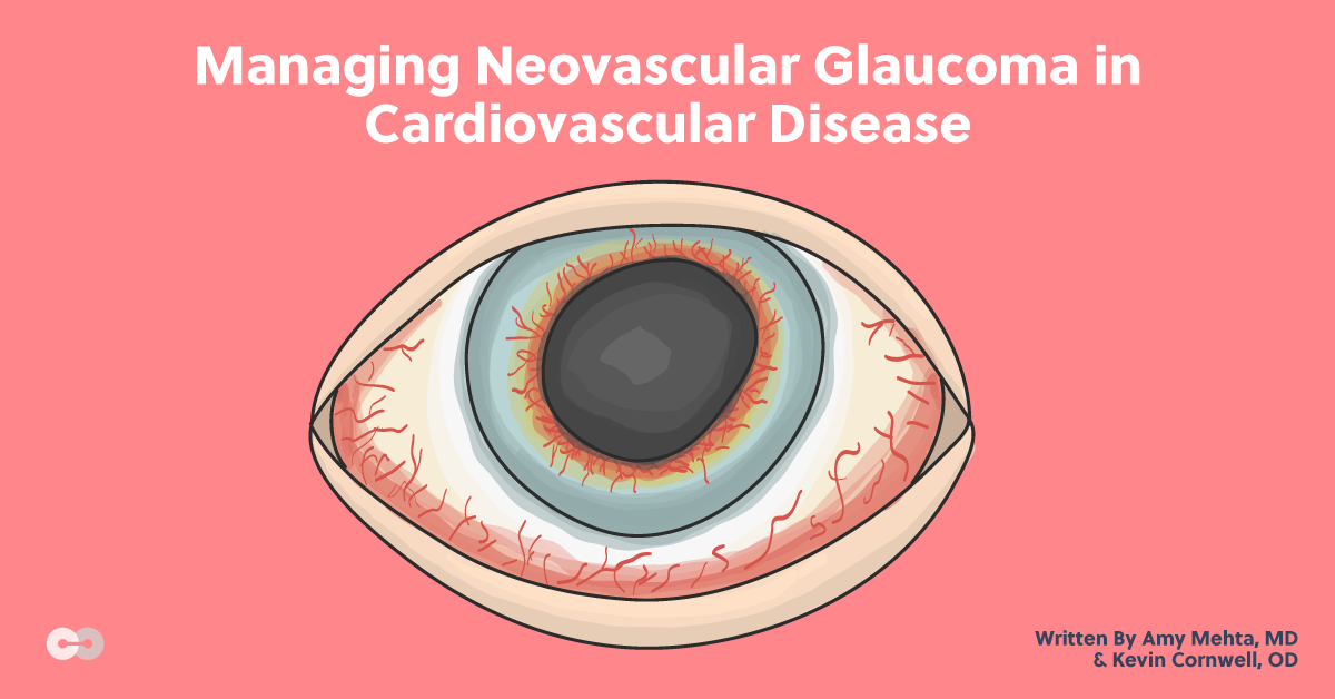 Managing Neovascular Glaucoma in Cardiovascular Disease