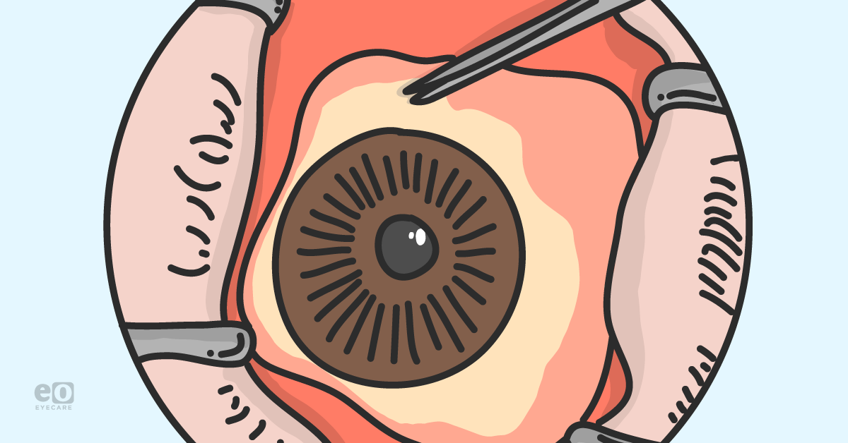 The OD's Guide to Sustained Release Glaucoma Treatments