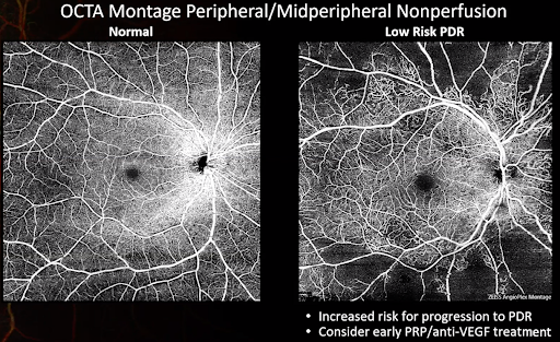 Patient with Peripheral Nonperfusion