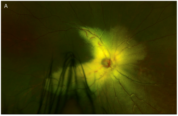 Myelinated retinal nerve