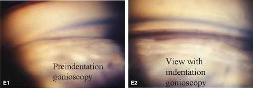 preindentation-indentation-gonioscopy.jpg