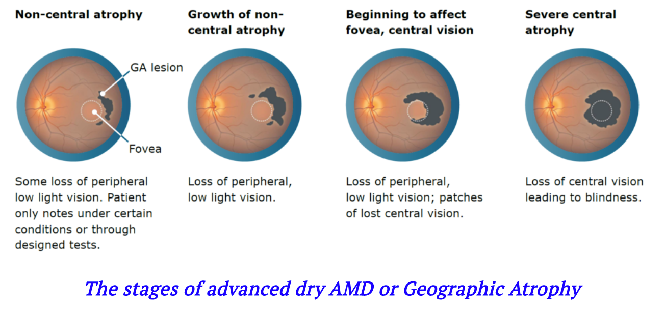 Pegcetacoplan Treatment for Dry AMD or GA