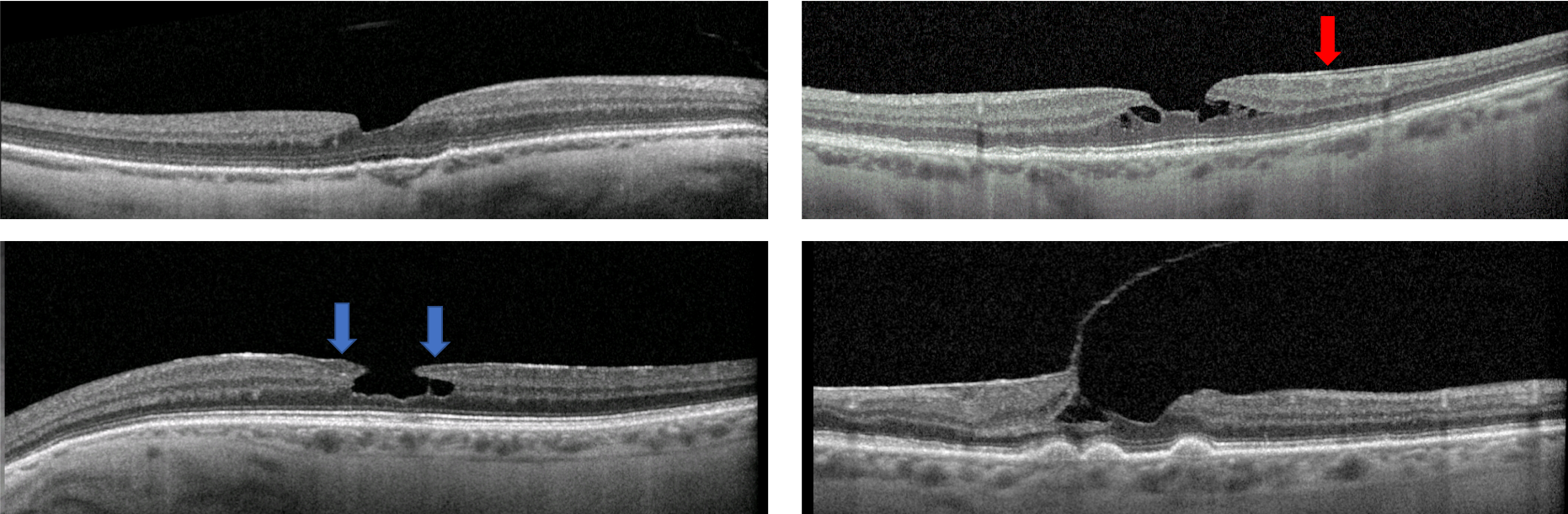 Lamellar Macular Hole OCT Imaging