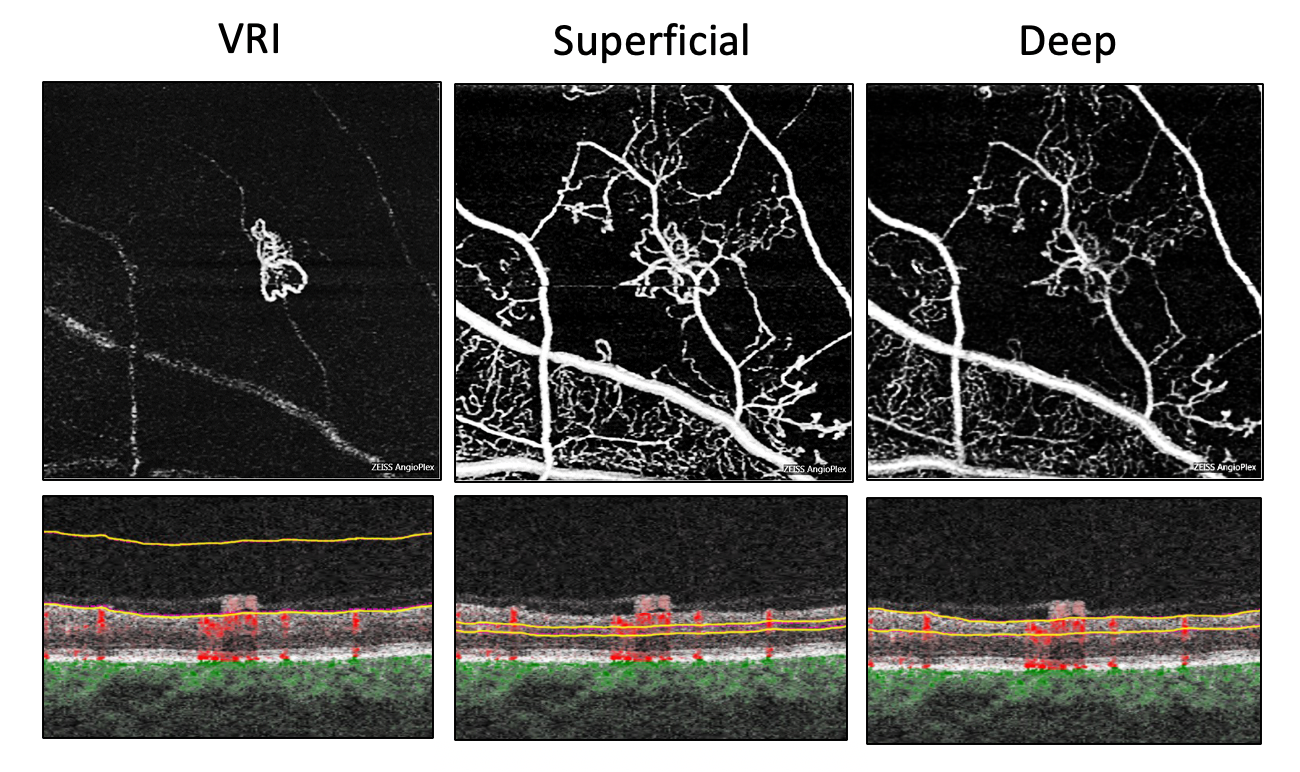 Sequential OCTA maps (above) and B scan blood flow overlays (below)