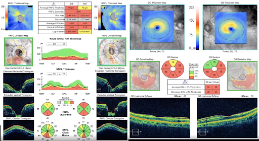 OCT and Ganglion Cell Analysis