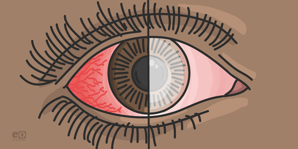 A Patient's Perspective on Acanthamoeba Keratitis