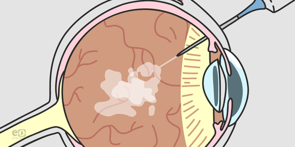 What to Know About the Vabysmo Bispecific Antibody Treatment for Wet AMD and DME