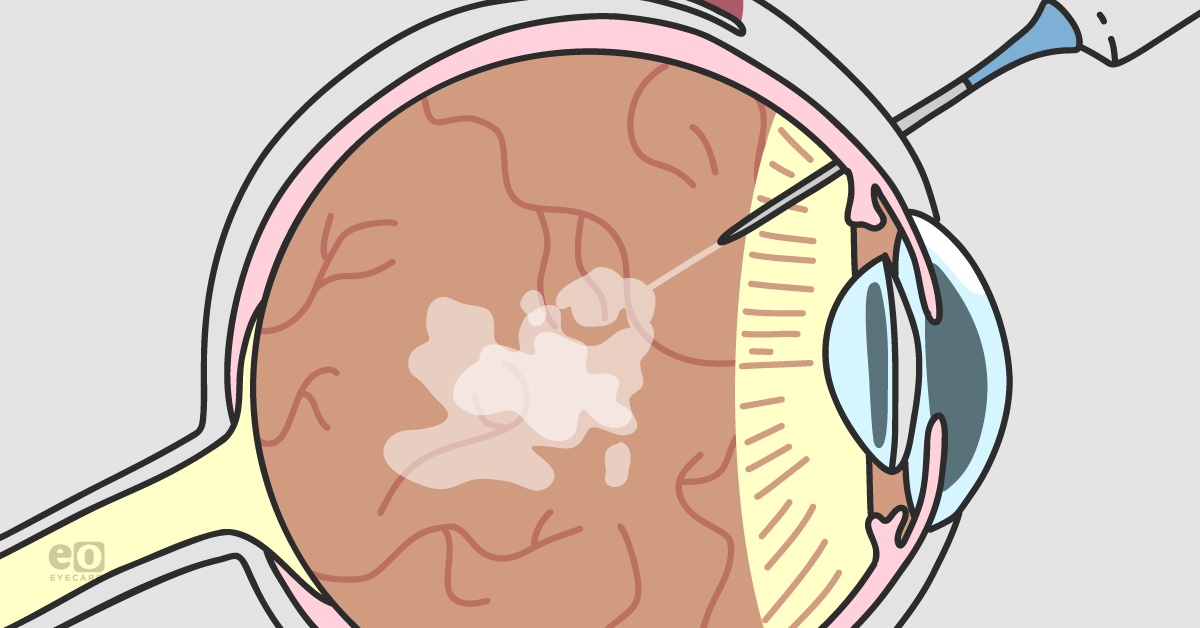 What to Know About the Vabysmo Bispecific Antibody Treatment for Wet AMD and DME