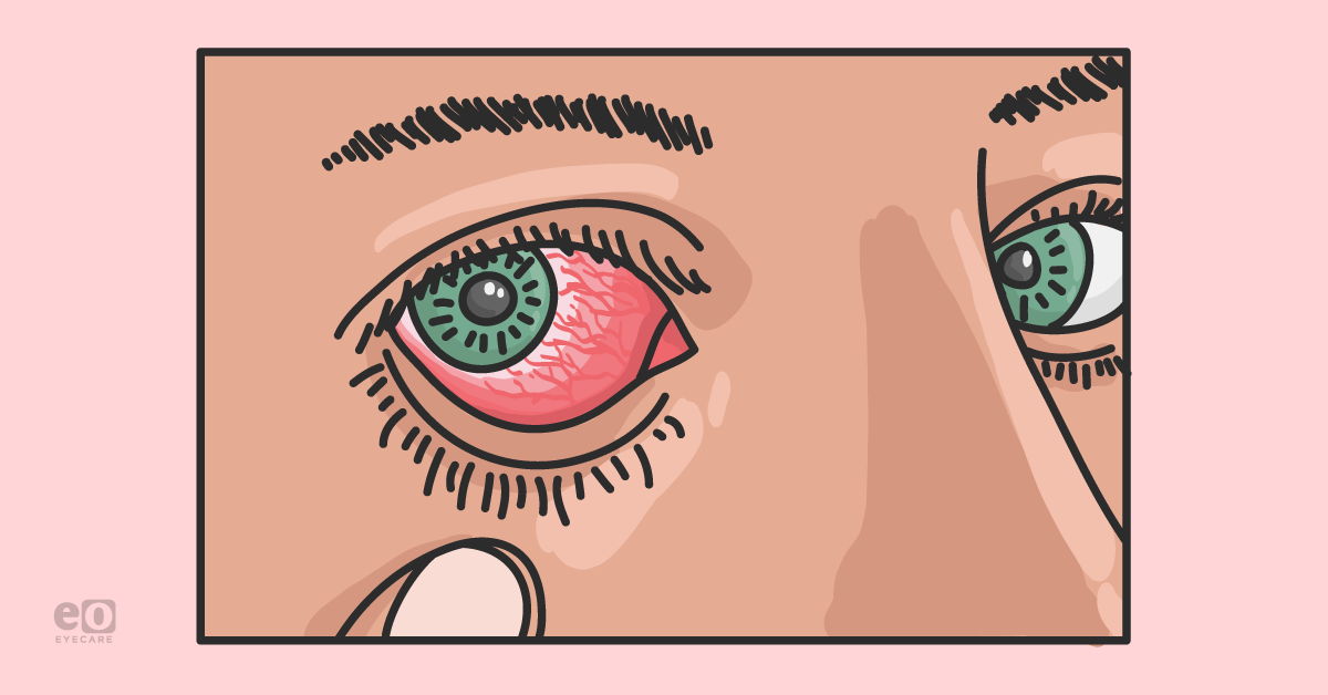 Identifying Optimal Image Selection for Posterior Uveitis