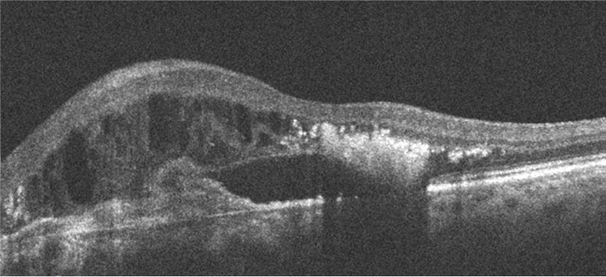 Atrophic lesion development OCT