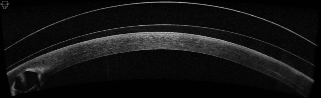 Scleral lens OCT