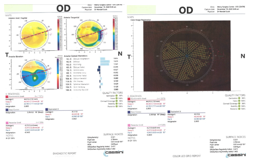 scott case 3 figure 4 jjv astigmatism