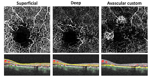 Macular Telangiectasia left eye second image SD