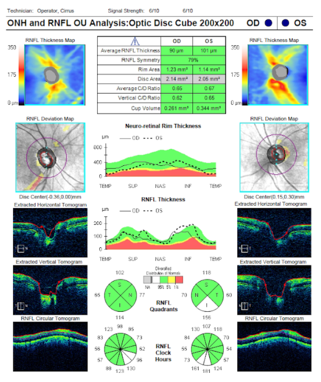 ONH-RNFL Cube Analysis Glaucoma Suspect.png