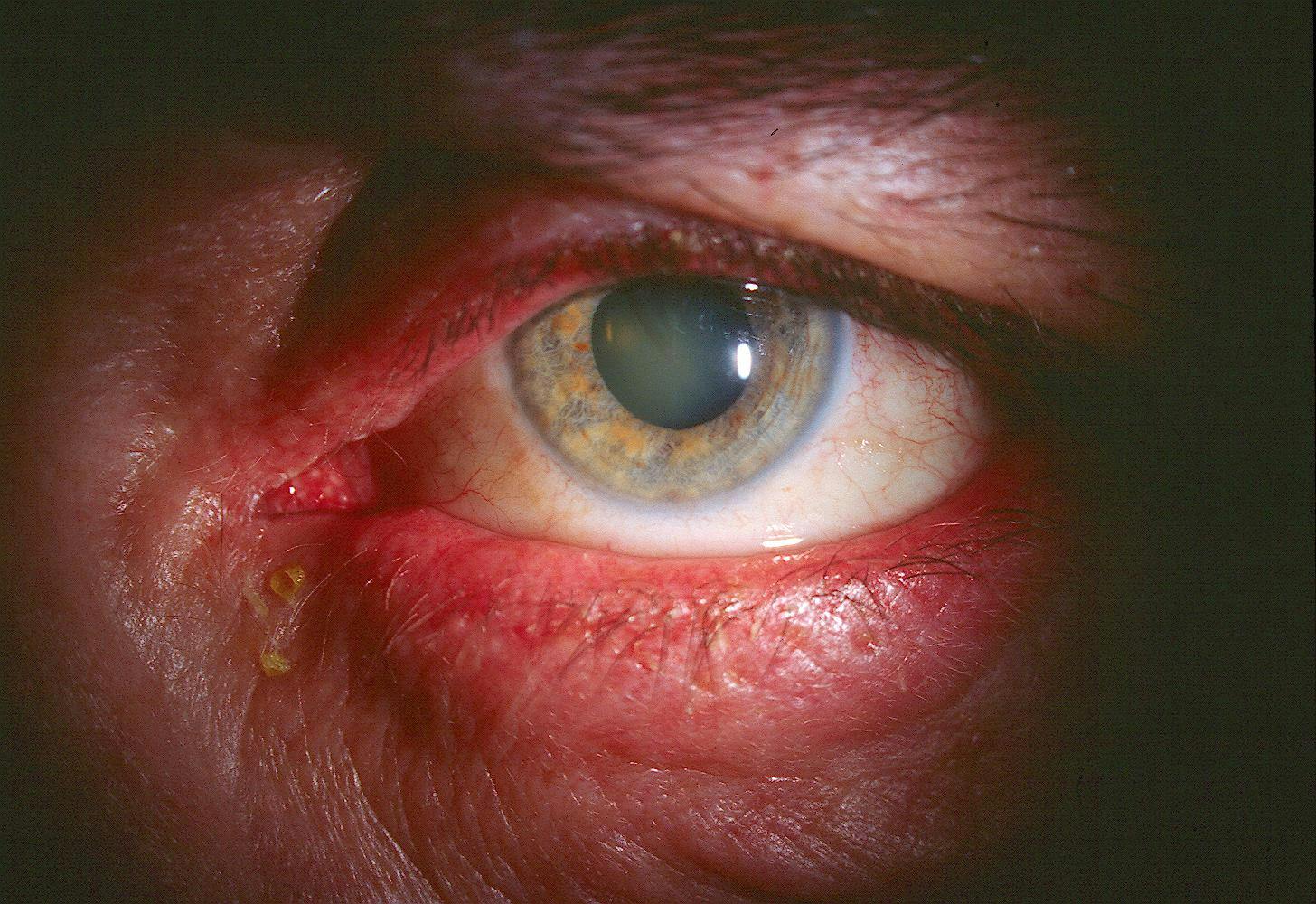 Bilateral blepharitis