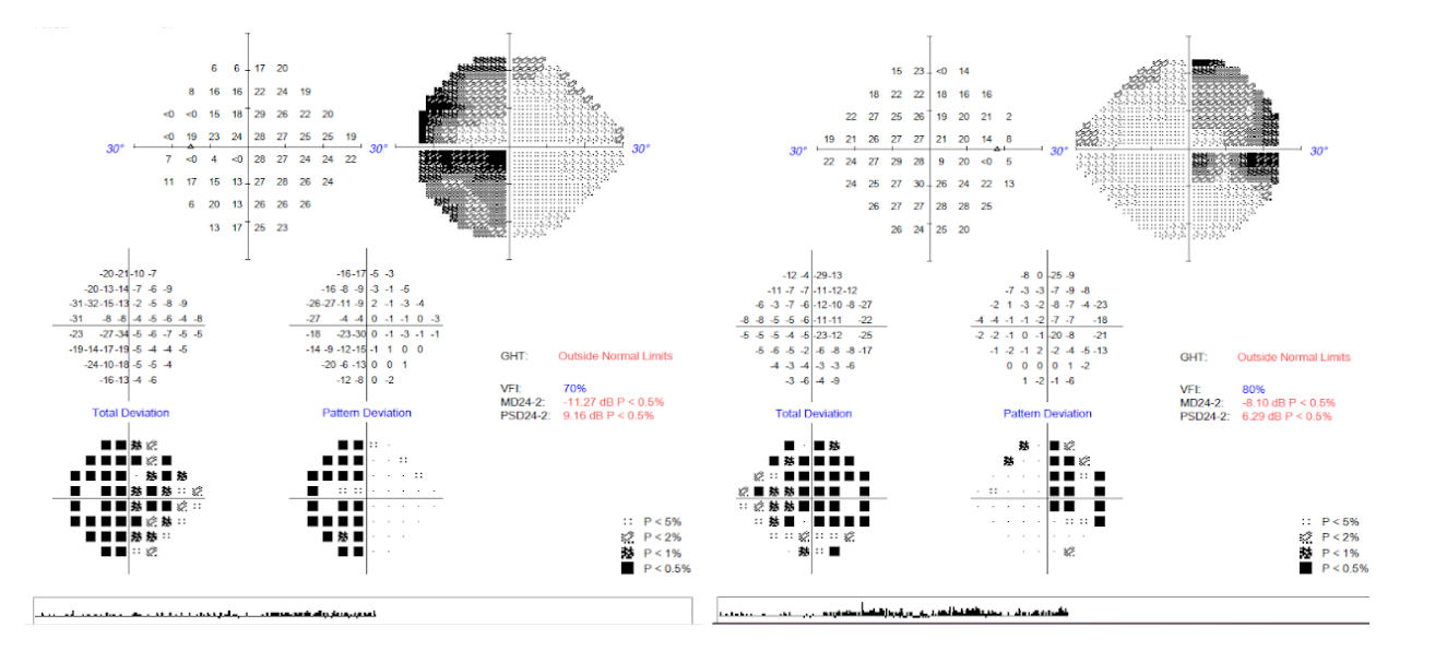 Visual Field Glaucoma Suspect.png