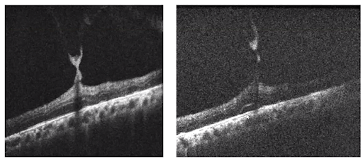 Macular OCT Scan