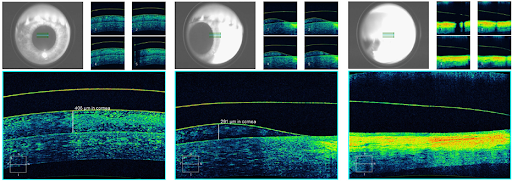 Boston Sight Scleral