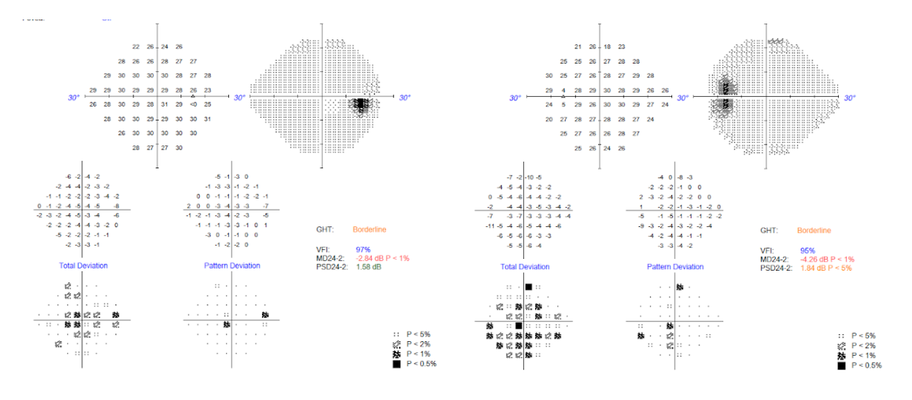 Visual Filed Exam Results.png