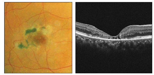 Macular Telangiectasia fundus exam