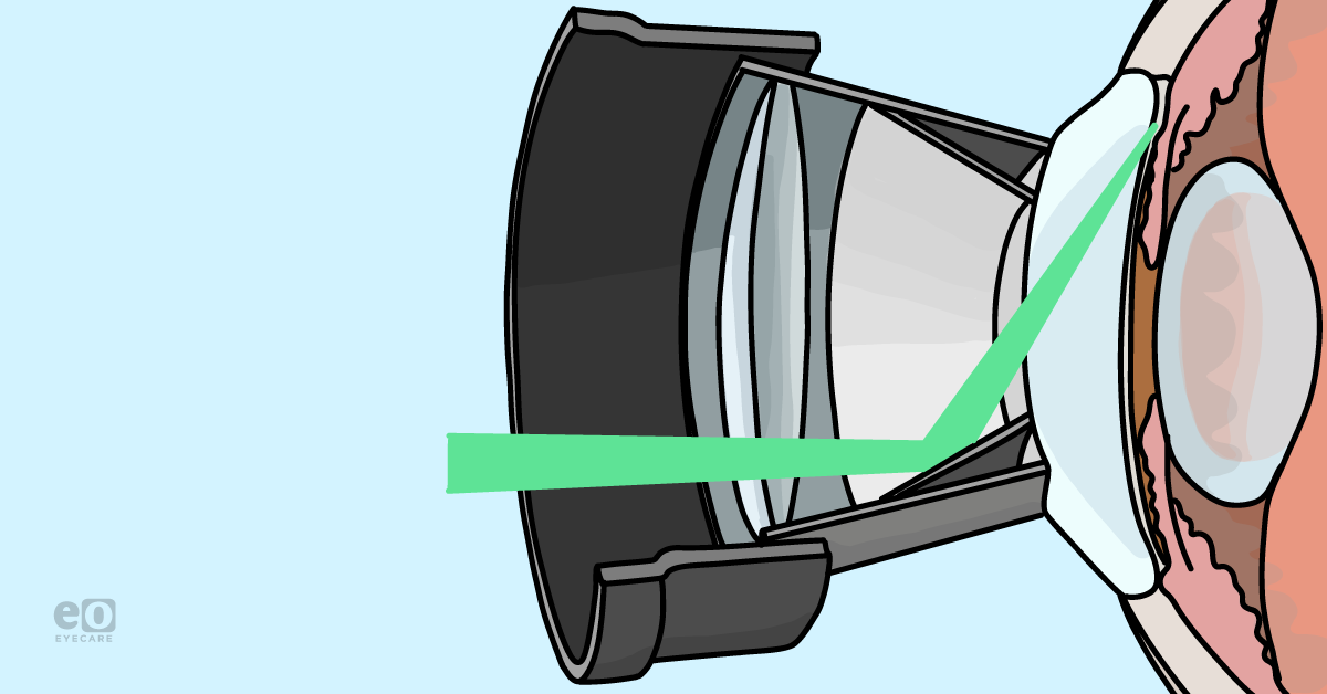 Where Selective Laser Trabeculoplasty (SLT) Fits in the Glaucoma Treatment Paradigm