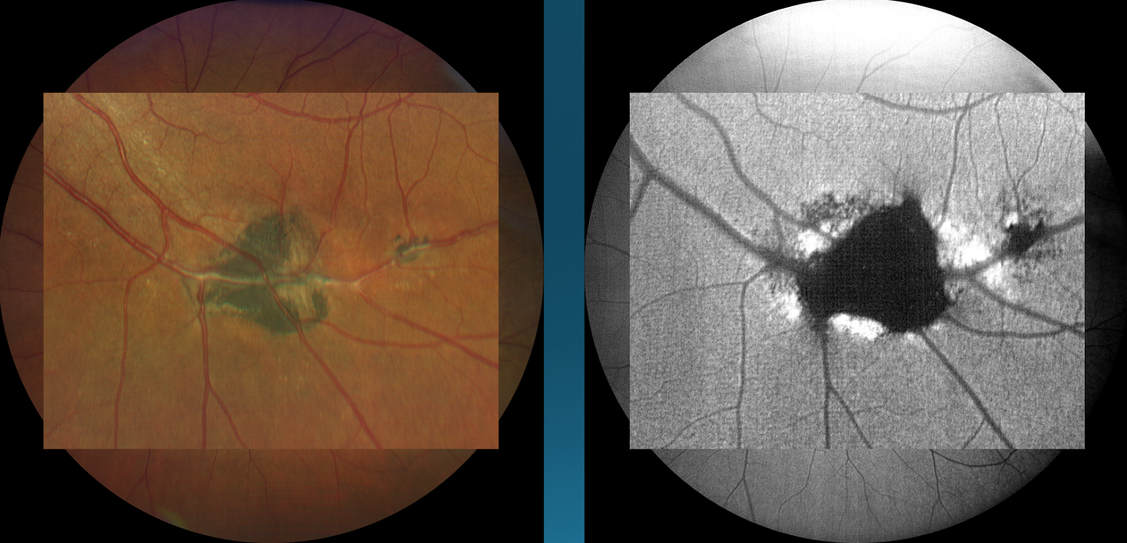 On the right-hand side is a picture of a patient’s left eye revealing a chorioretinal scar. Is this scar active or inactive?