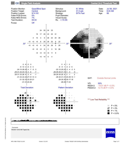 Visual Field OD Patient Case 2