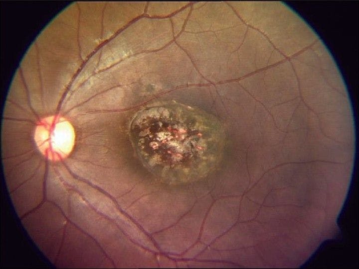 Toxoplasmosis chorioretinitis