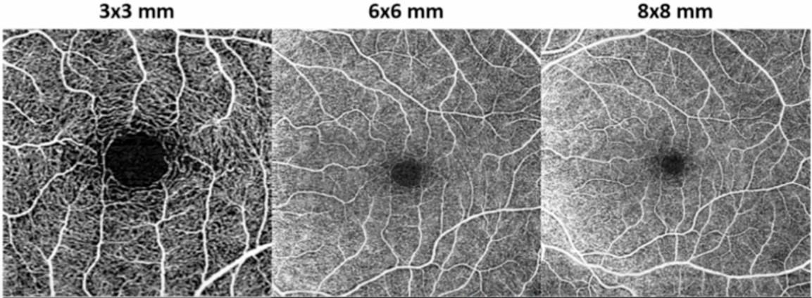 OCTA healthy retina 