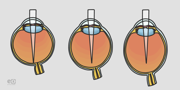 Scleral Collagen Cross-Linking to Stop Myopia Progression