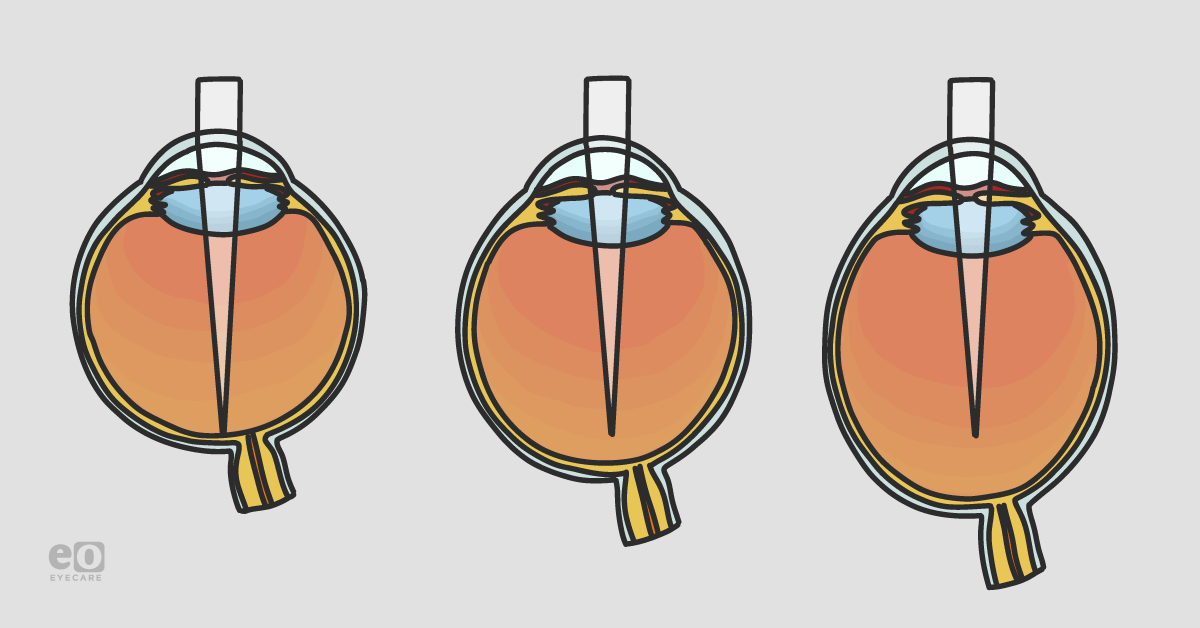 Scleral Collagen Cross-Linking to Stop Myopia Progression