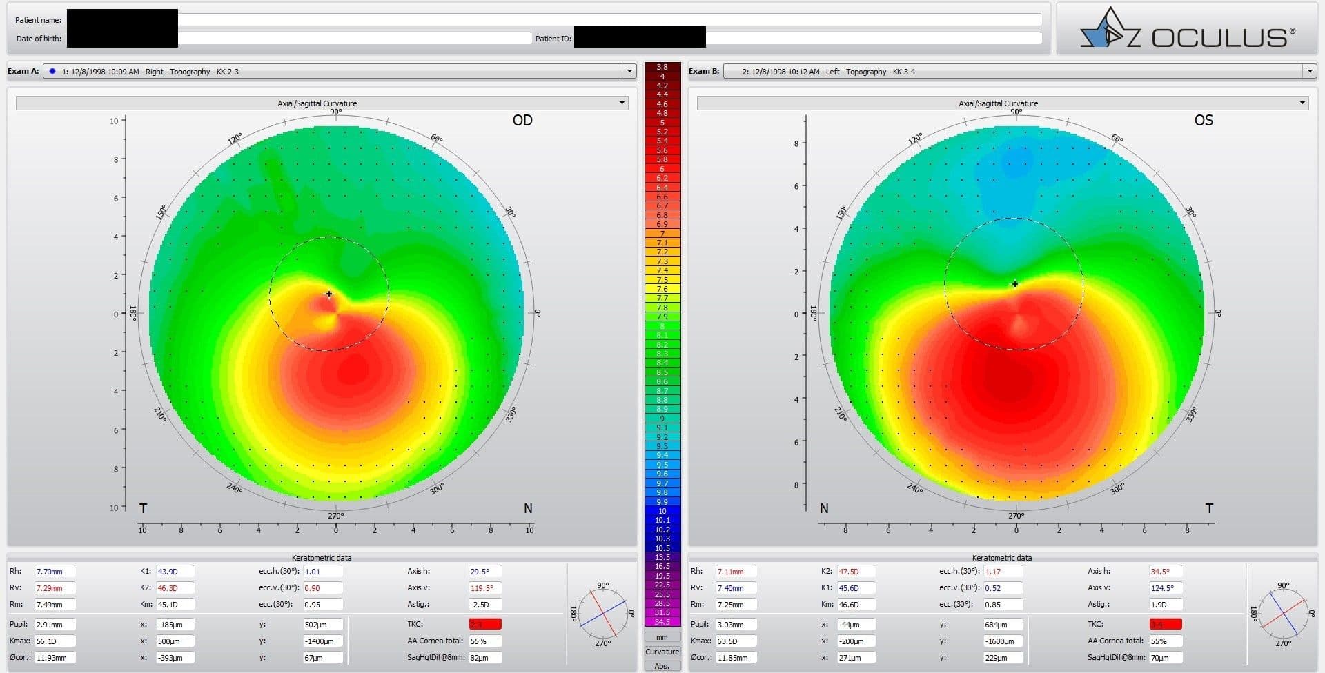 keratoconus topography