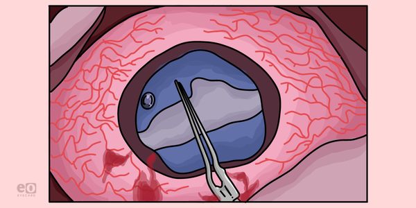 Case Report: The Challenges of White Cataracts