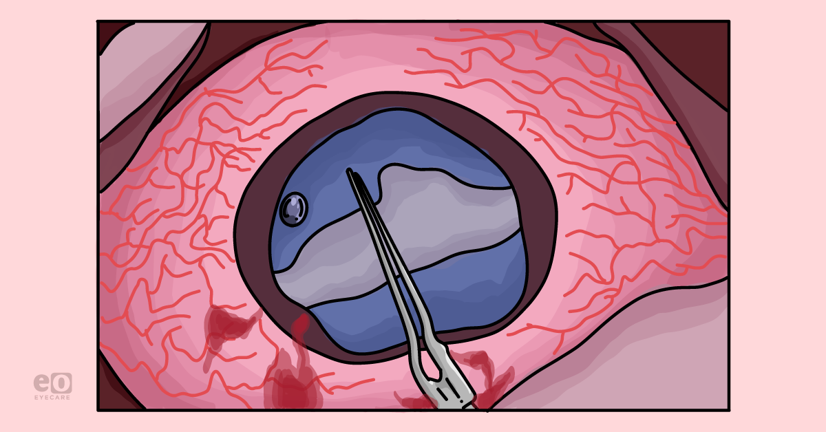 Case Report: The Challenges of White Cataracts